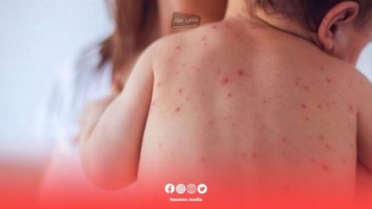 Suspected Measles Case Claims Life of Infant in Fes